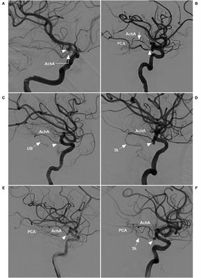 Endovascular Treatment and Angiographic Characteristics of Aneurysms at the Origin of the Anterior Choroidal Artery